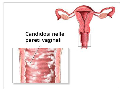 Candidosi nelle pareti vaginali