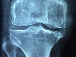 Salute ossea in menopausa