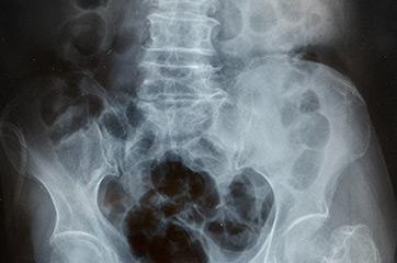 Osteoporosi in menopausa