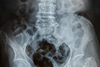 Quanto ne sai della manifestazione e diagnosi dell'osteoporosi?